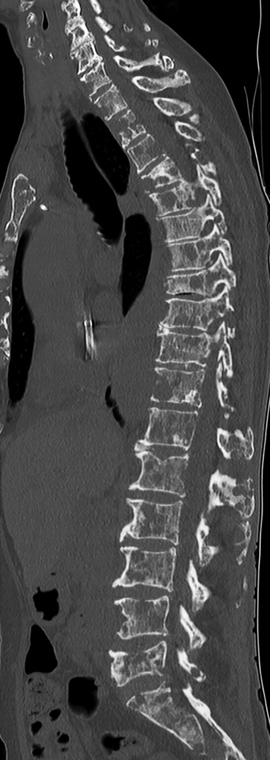 Abb.16.10-Multiples-Myelom-mit-diffuser-osteolytischer-Durchsetzung-des-Achsenskeletts