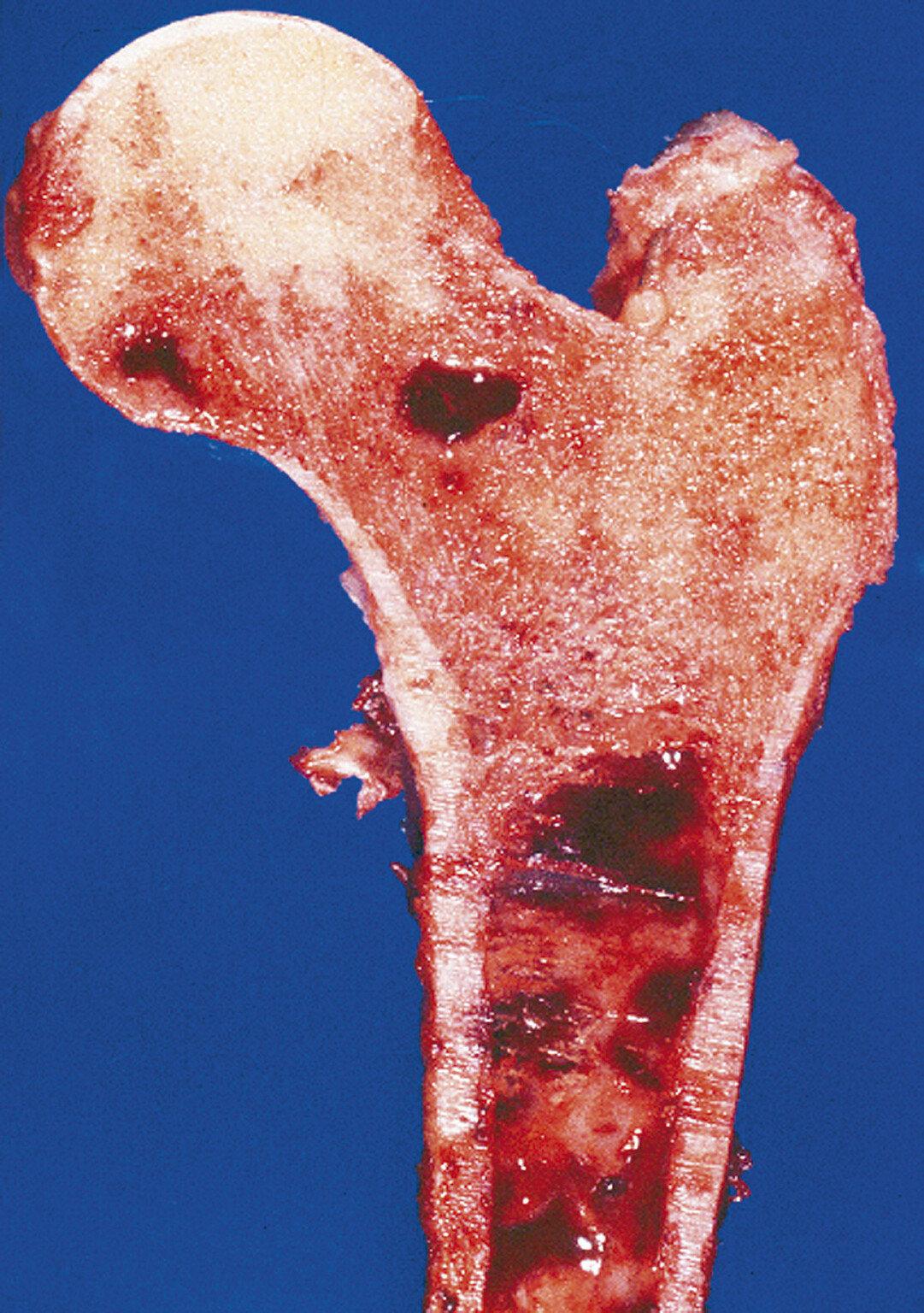Abb.16.1Makroskopisches-Präparat-des-proximalen-Femurs-mit-Nachweis-mehrerer-Herde-eines-Myeloms