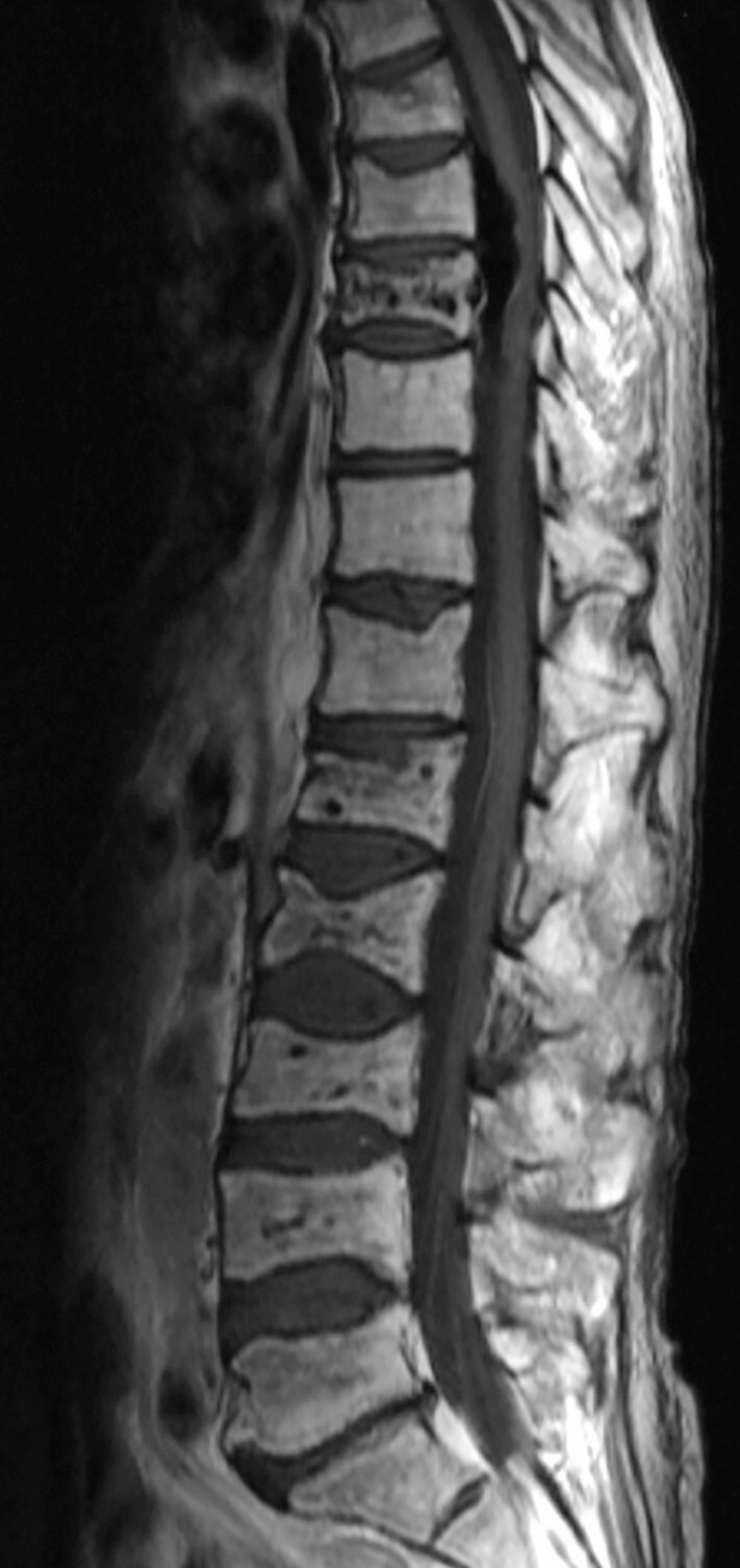 Abb.16.4b-Multiples-Myelom-mit-Manifestation-im-Bereich-der-LWS