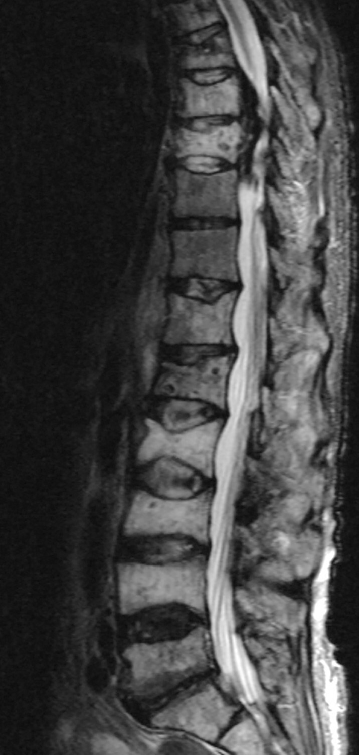 Abb.16.4c-Multiples-Myelom-mit-Manifestation-im-Bereich-der-LWS