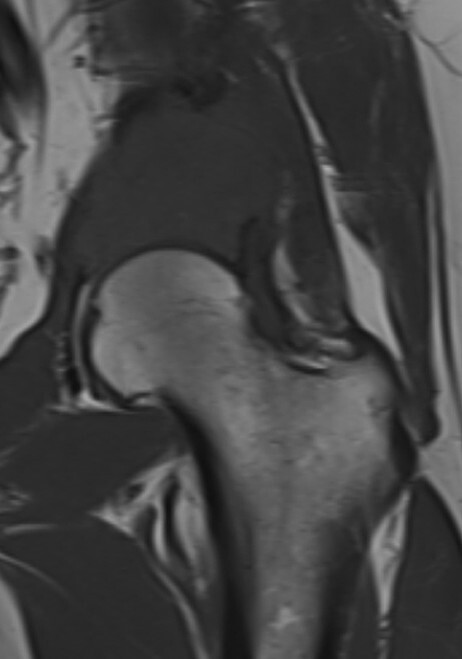 Abb.16.5b-Supraazetabuläre-Osteolyse-bei-Multiplem-Myelom