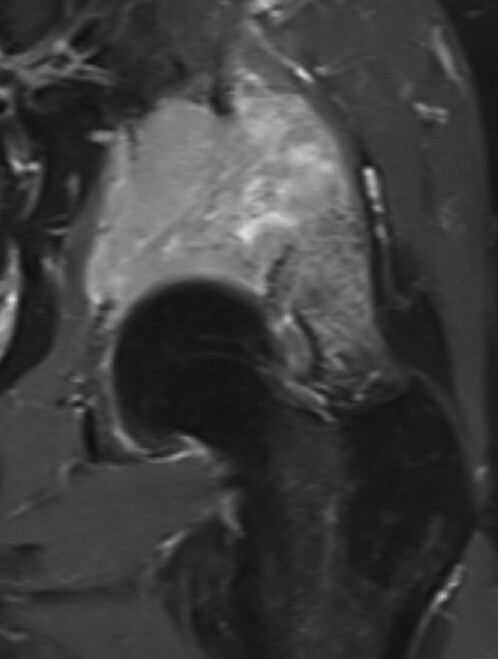 Abb.16.5c-Supraazetabuläre-Osteolyse-bei-Multiplem-Myelom