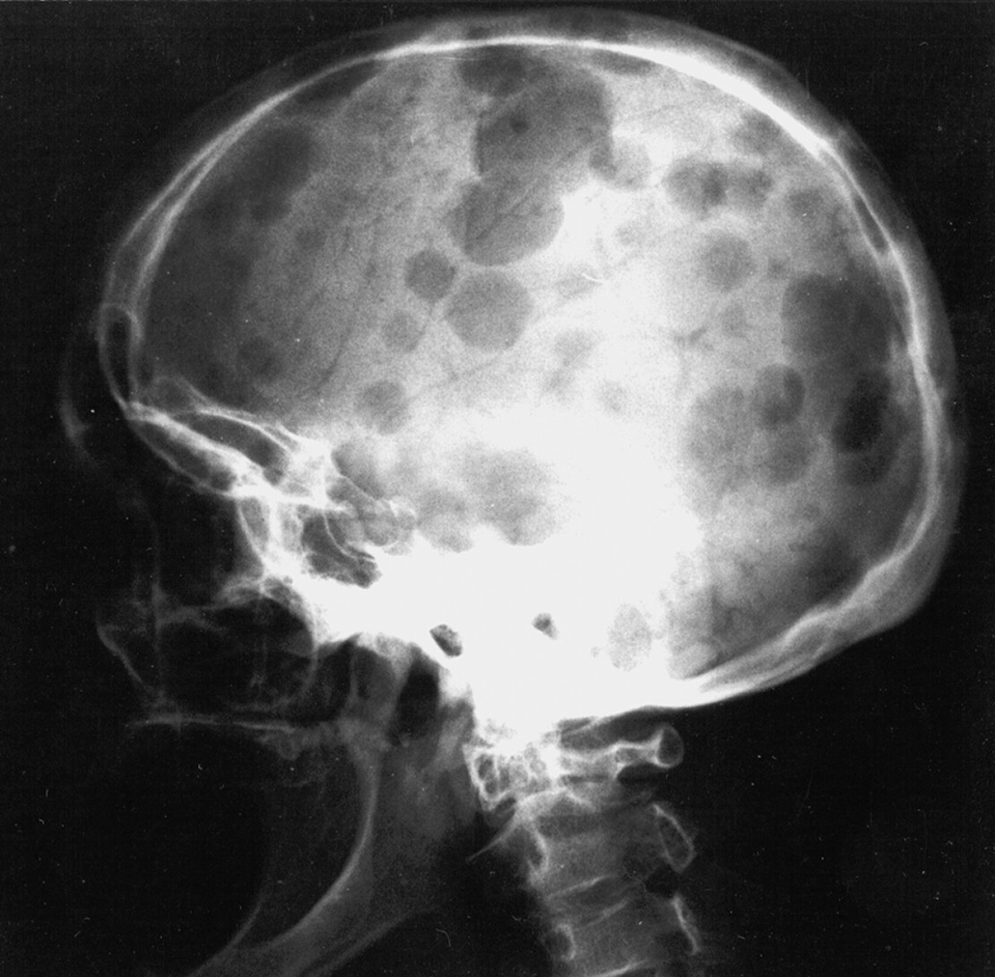 Abb.16.6-Osteolysen-der-Schädelkalotte-bei-multiplem-Myelom