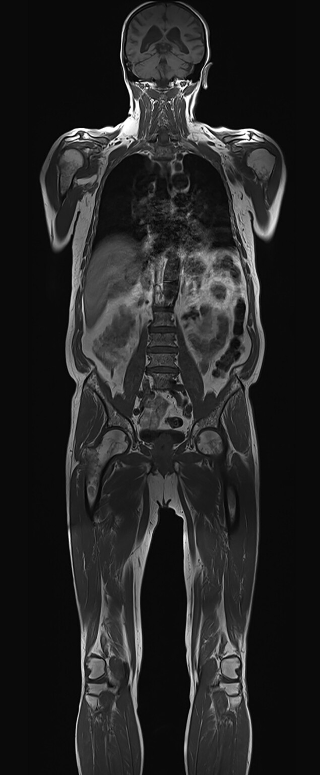 Abb.16.8a-Multiples-Myelom-in-der-vergleichenden-MRT-Darstellung