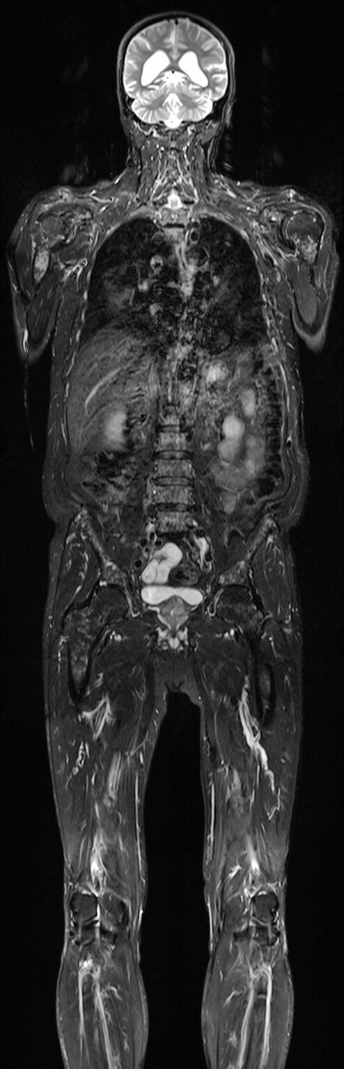 Abb.16.8b-Multiples-Myelom-in-der-vergleichenden-MRT-Darstellung