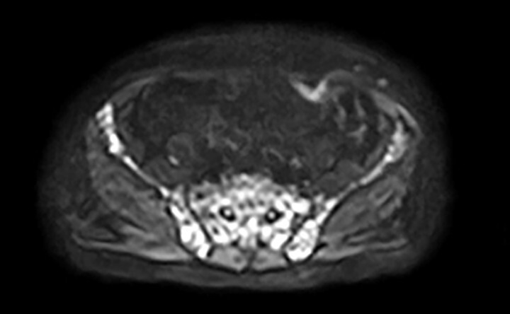Abb.16.8c-Multiples-Myelom-in-der-vergleichenden-MRT-Darstellung