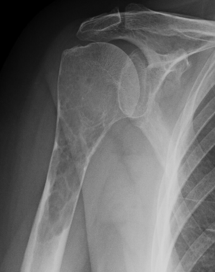 Abb.16.9a-Myelomherd-der-Humerusmetadiaphyse